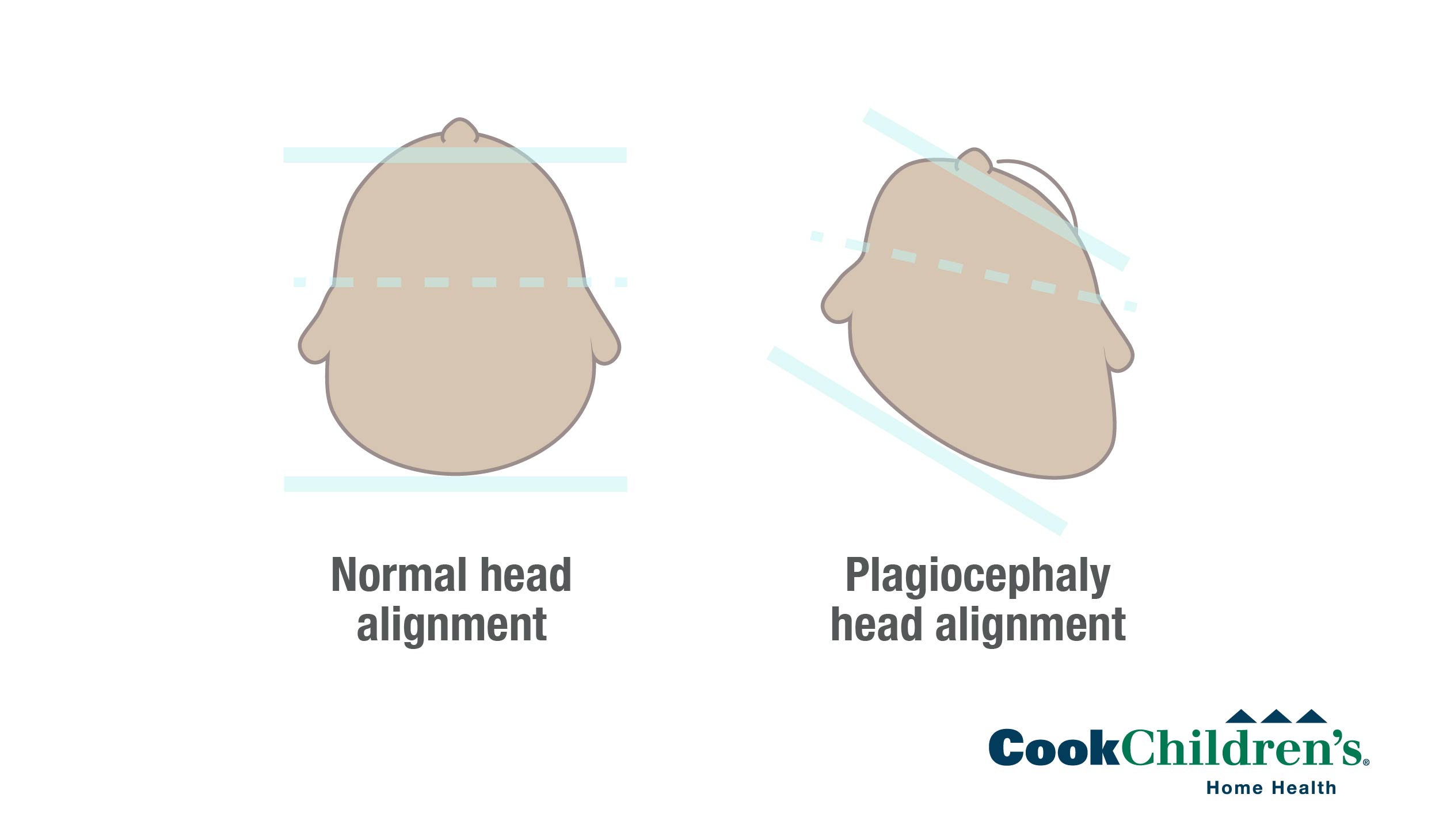 Positional plagiocephaly