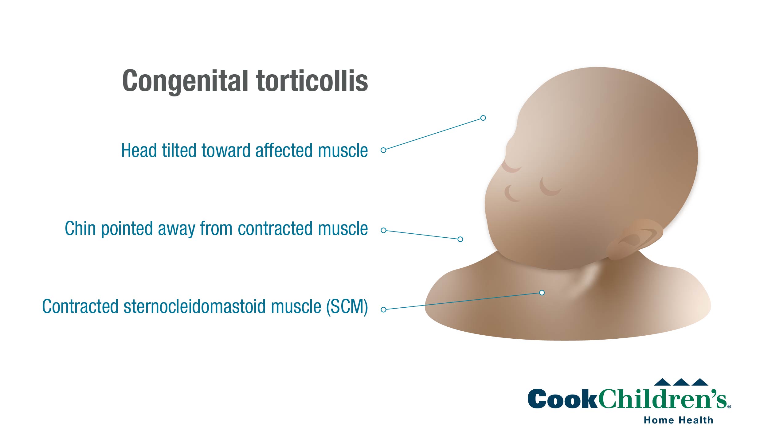 Congenital Torticollis